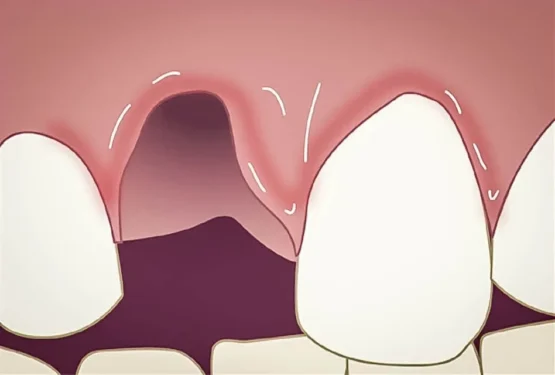 بیرون آمدن دندان از جای خود